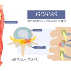 Ako poraziť ischias – cviky na zápal sedacieho nervu
