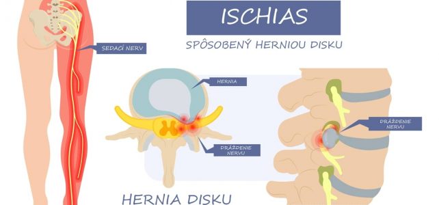 Ako poraziť ischias – cviky na zápal sedacieho nervu